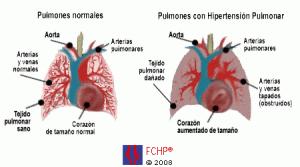 fchp_pulmones